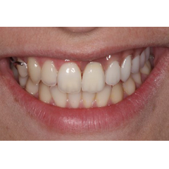 Smile of a patient with partial denture