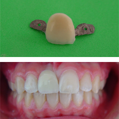 anterior missing teeth and a maryland bridge