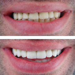 replacement of fixed partial dentures 