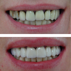 replacement of fixed partial dentures, before and after