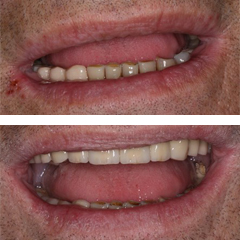 Fixed partial denture before and after