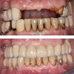 fixed partial denture before and after