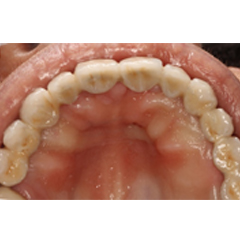 MetalCeramic implant fixed bridge in the mouth