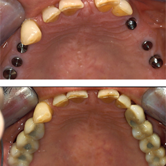 Replacement of posterior missing teeth with dental implants for a perio patient