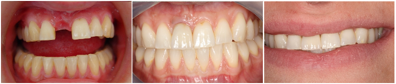 Οδοντικό εμφύτευμα στον κεντρικό τομέα πριν και μετά