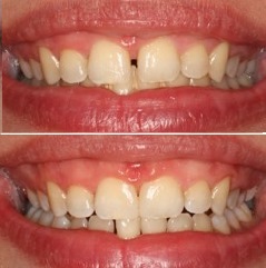 όψεις ρητίνης για κλείσιμο κενών ανάμεσα στα δόντια