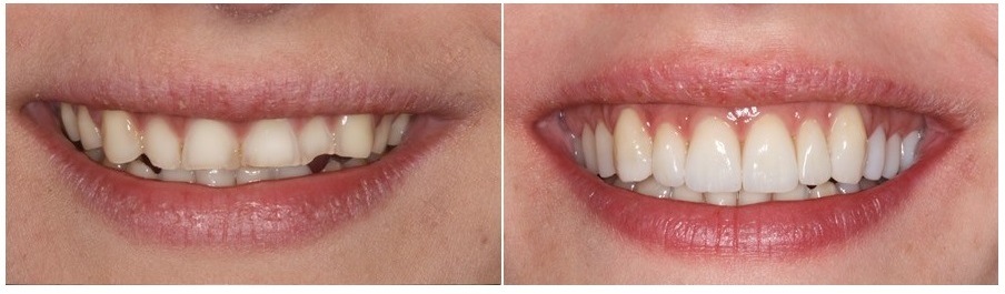 αποκατάσταση πρόσθιων δοντιών με όψεις πορσελάνης σε ασθενή με βουλιμία