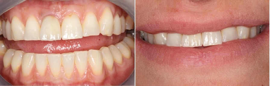 Εικόνα δοντιών και χαμόγελου σε ασθενή 25 ετών
