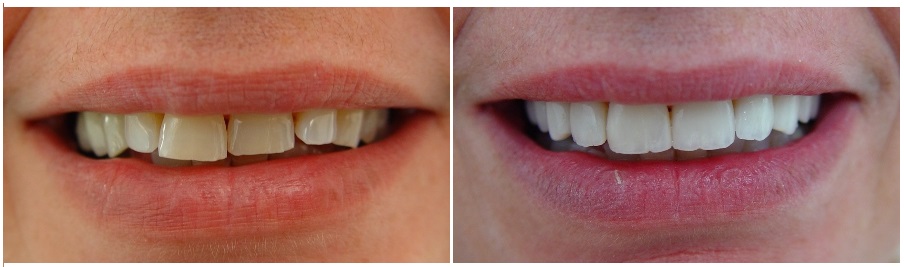 αποτριβές πρόσθιων δοντιών και αποκατάσταση με όψεις πορσελάνης