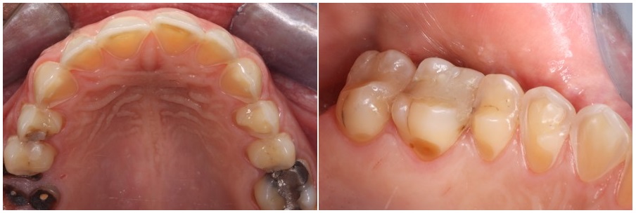 teeth erosion due to vomiting