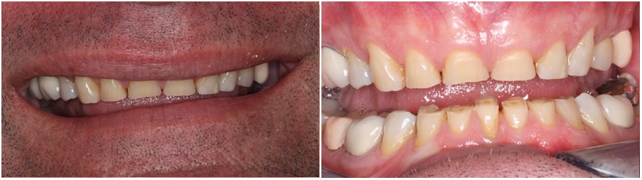 Αποτριβή των δοντιών και αντιμετώπιση με ελάχιστη παρέμβαση