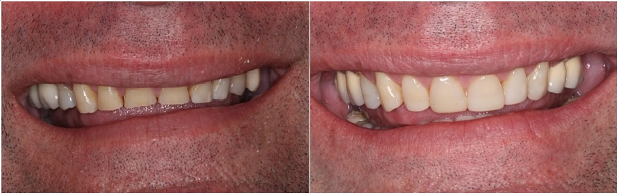 Ολική στοματική αποκατάσταση σε αποτριβή δοντιών-πριν και μετα 