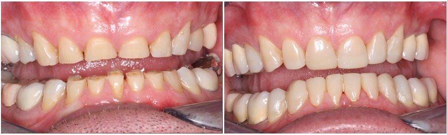 αποτριβή δοντιών-πριν και μετά, αποκατάσταση πρόσθιων δοντιών με σύνθετη ρητίνη