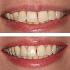 fixed partial dentures 