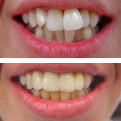 all ceramic fixed partial denture