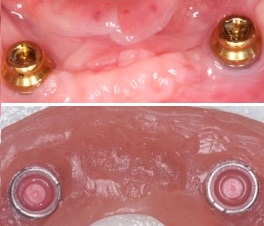 Συγκρατητικοί μηχανισμοί σε οδοντοστοιχία επένθετη σε εμφυτεύματα