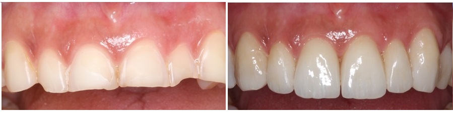 teeth erosion, before and after, the sandwich technique
