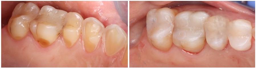 Επένθετα ρητίνης σε οπίσθια δόντια πριν και μετά την συγκόλληση τους