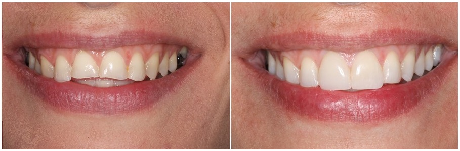 Before and after prosthetic rehabilitation of eroded teeth with bonded restorations