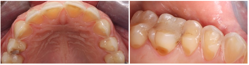 teeth erosion due to vomiting during pregnacy