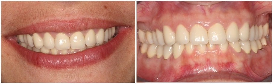 Restoration of eroded teeth with galvano-ceramic crowns