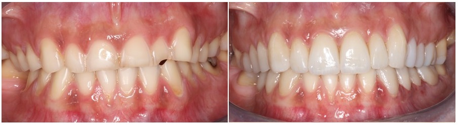 Προσθετική αποκατάσταση διάβρωσης των δοντιών