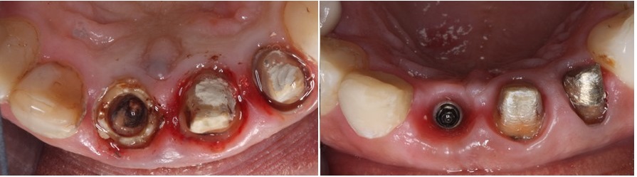 προφίλ ανάδυσης δοντιού πριν την εξαγωγή του και μετά την αντικατάσταση του με εμφύτευμα
