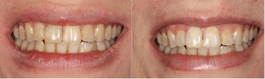 εσωτερική λεύκανση δοντιού-πριν και μετά