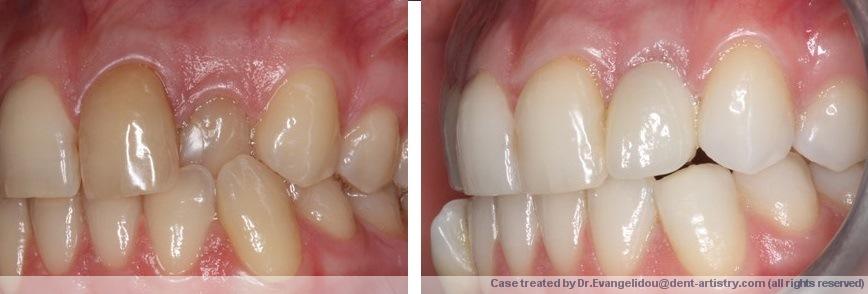 αισθητική οδοντιατρική-πριν και μετά
