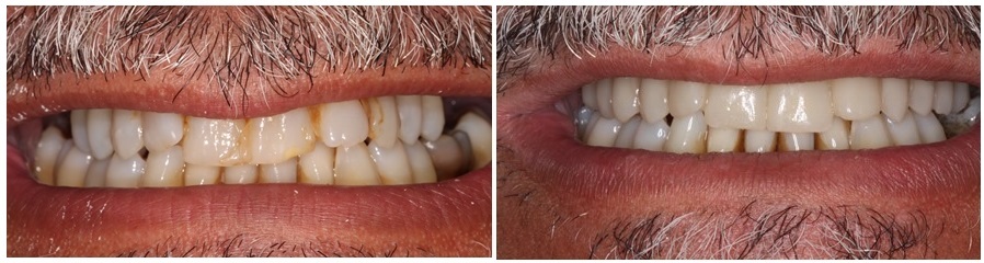 Οδοντικά εμφυτεύματα -πριν  και μετά την απώλεια φυσικών δοντιών