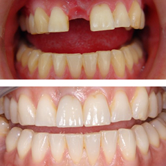 Missing central incisor and treatment with a dental implant