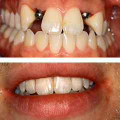 ολοκεραμικές στεφάνες σε οδοντικό εμφύτευμα και συγγενή έλλειψη πλαγίου