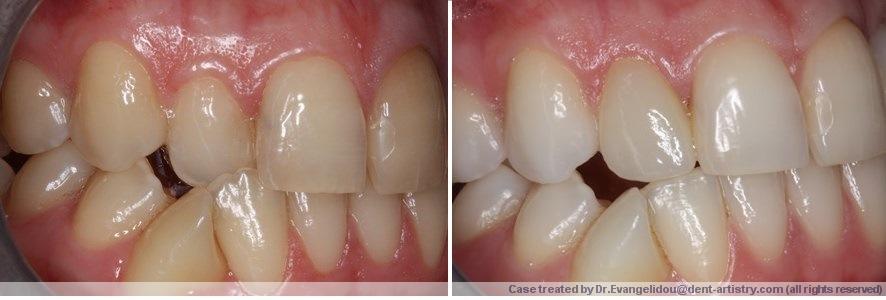 αισθητική οδοντιατρική-πριν και μετά