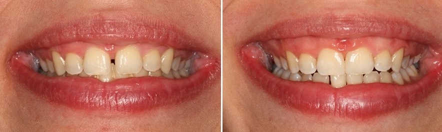 Κενό στα δόντια και διόρθωση με όψεις ρητίνης