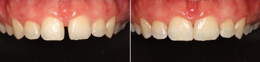 Κενό στα δόντια και διόρθωση με όψεις ρητίνης