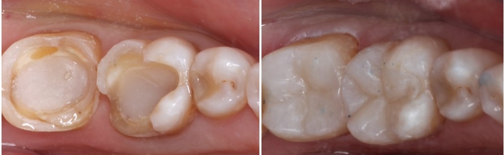 Επένθετα σε οπίσθια δόντια