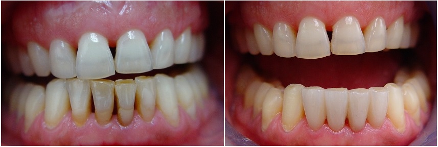 Κενό στα κάτω δόντια και διόρθωση με όψεις πορσελάνης