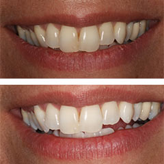 ZOOM whitening before and after