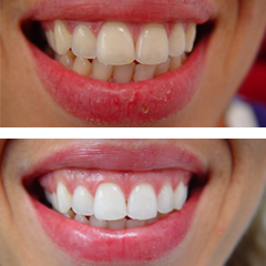iΛεύκανση δοντιών πριν και μετά 