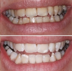 Λεύκανση δοντιών-πριν και μετά