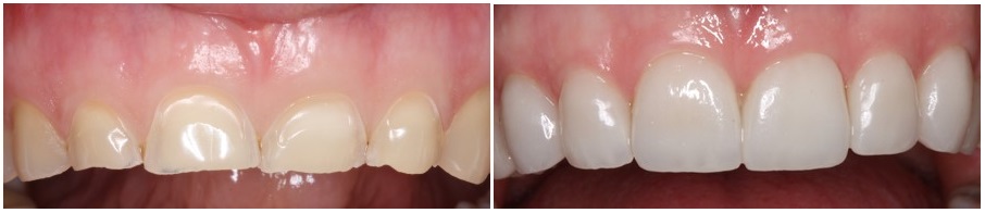 Διάβρωση δοντιών- θεραπεία- οψεις πορσελάνης