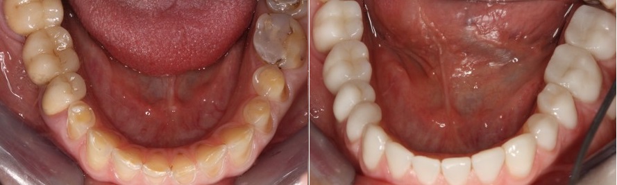 Διάβρωση δοντιών- θεραπεία