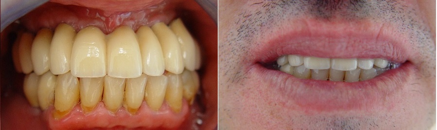 Ολική στοματική αποκατάσταση σε δόντια και εμφυτεύματα