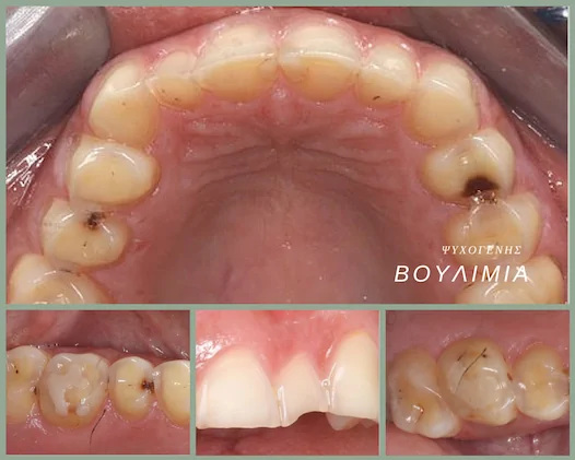 Διατροφικές διαταραχές και διάβρωση των δοντιών