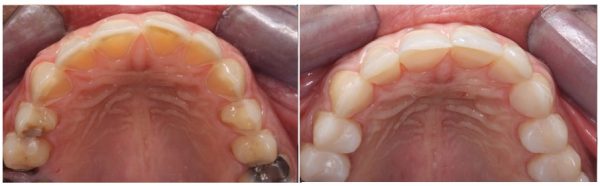 Dental erosion from hyperemesis gravidarum on the palatal surfaces of the anterior teeth