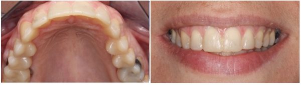 mock up of severely eroded dentition due to hyperemesis gravitarum