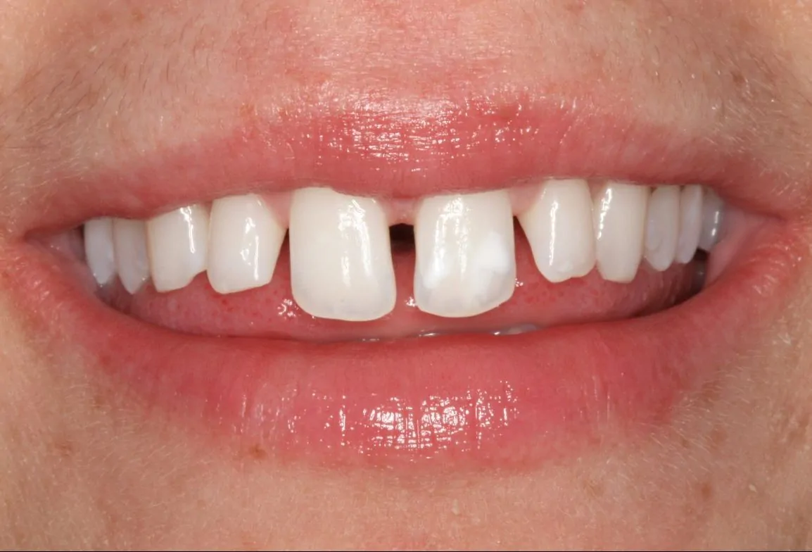 Small Teeth with Gaps Before Porcelain Veneer Treatment | DentArtistry