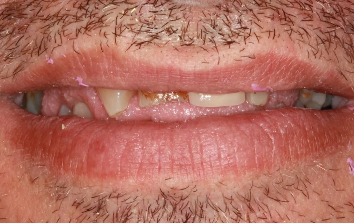Full Mouth Rehabilitation in a Patient with Multiple Missing Teeth and Loss of Vertical Dimension, before treatment
