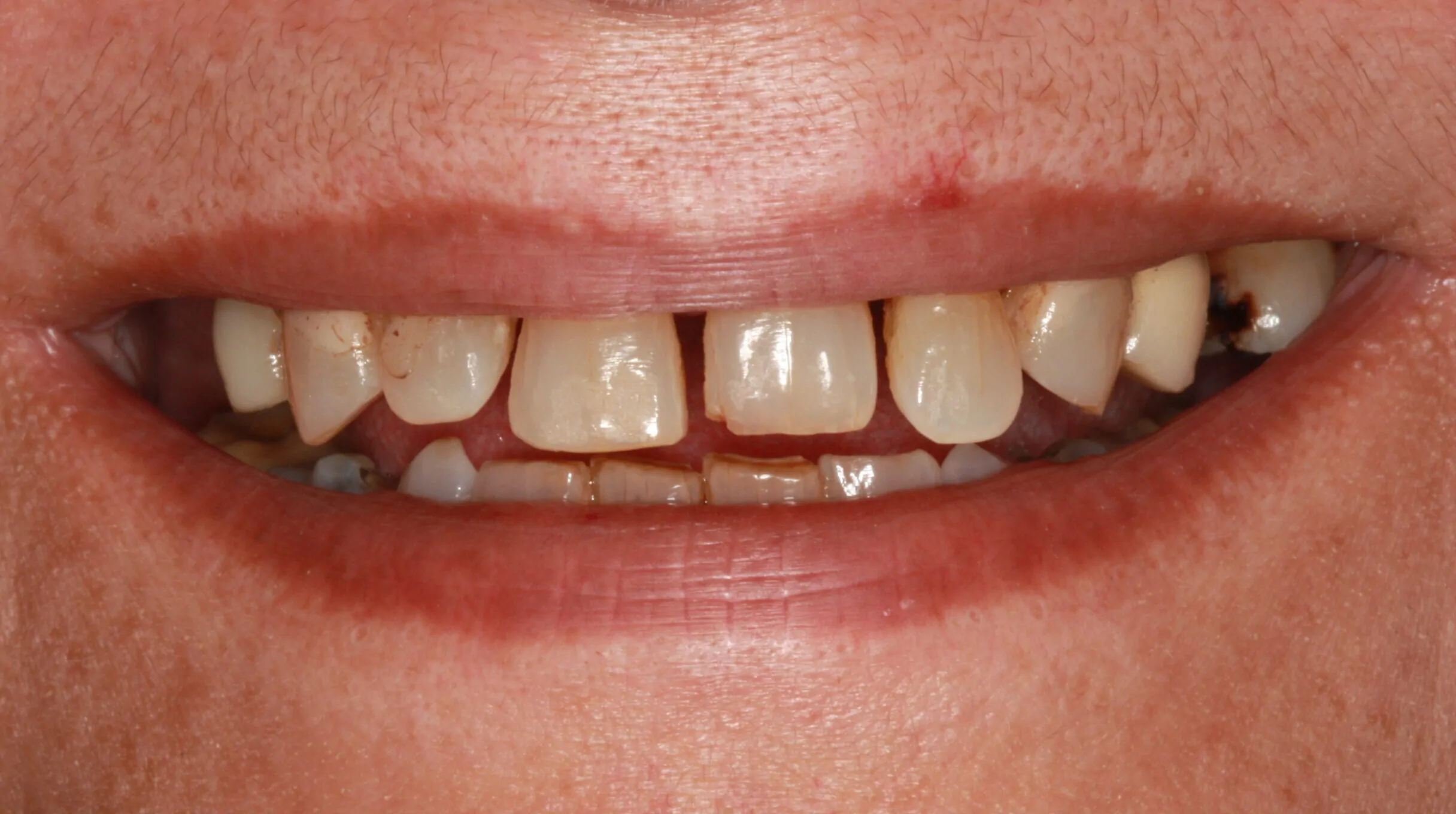Periodontal Patient Before Dental Implant Treatment