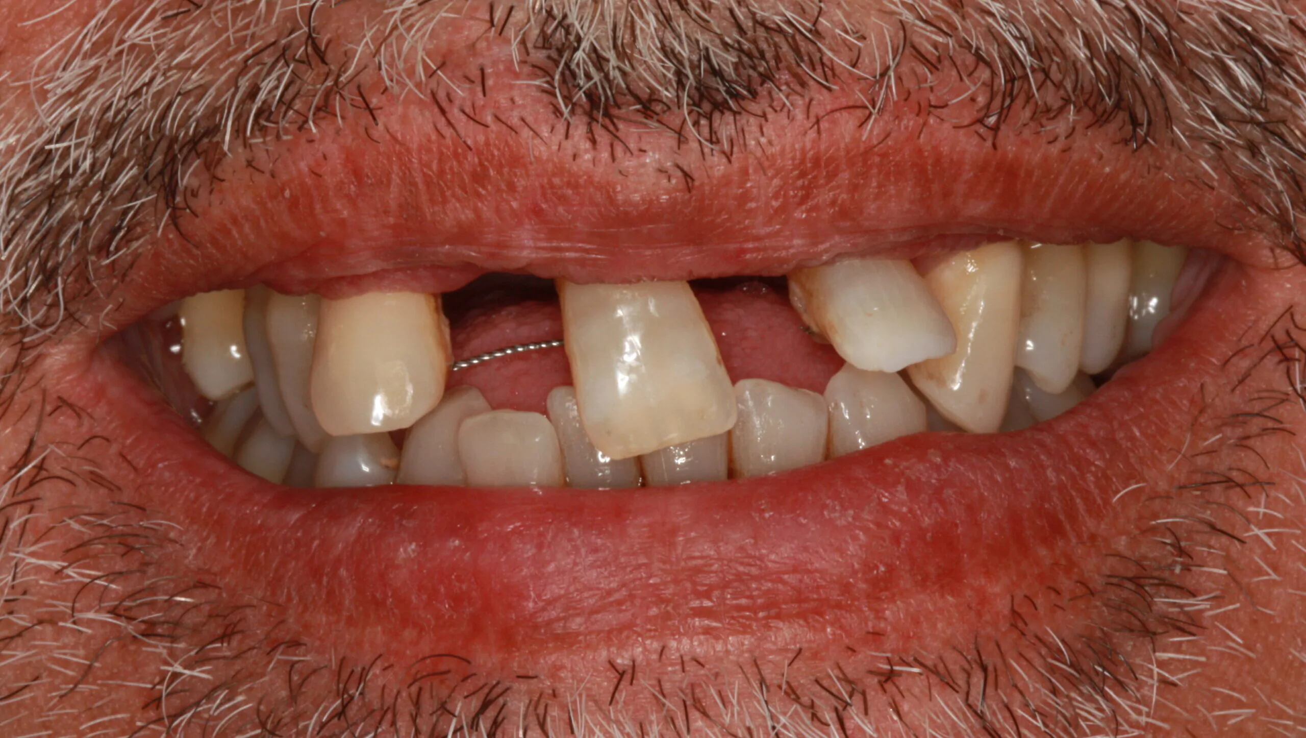 Periodontal Patient Before Dental Implant Treatment